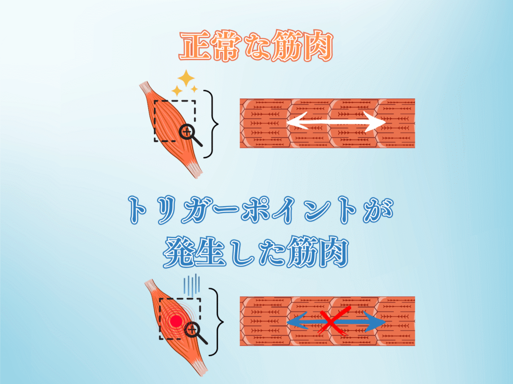 トリガーポイント鍼灸とは